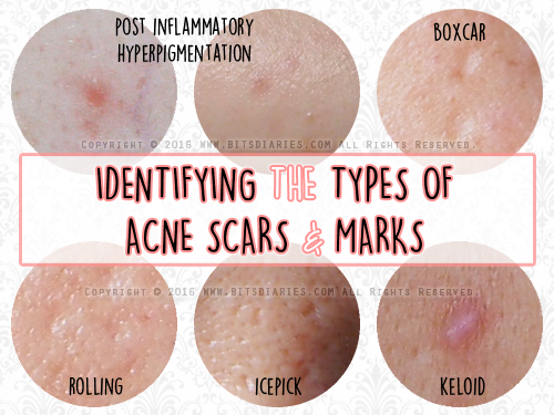 types of acne scars_1.png